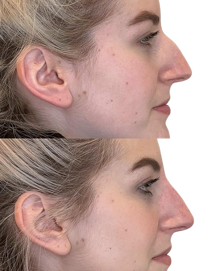 NonSurgical Nose Job Perth Rhinoplasty & Nose Filler
