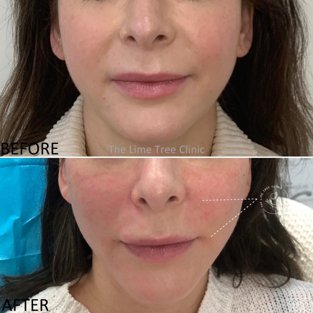 Thread Lift Perth PDO NonSurgical Face & Eyebrow Lift