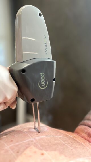 Surface treatments can only do so much. Pearl Laser goes deeper, where real skin damage lives.

✔️ Smooths scarring
✔️ Fades stubborn skin discolouration 
✔️ Boosts collagen from within
✔️ Restores skin tone & texture

And with winter’s low UV levels, it’s the perfect time to resurface, renew, and reset.

➖ This month: 5% OFF Pearl Laser treatments + a FREE prep pack, valued at $450

📍 Book your complimentary consultation today! 

* Results may vary, video consent was obtained. 

#thelimetreeclinic #perthcosmeticclinic #skinclinicperth
